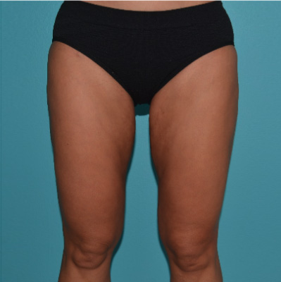 Tummy-tuck-p7-a1 After
