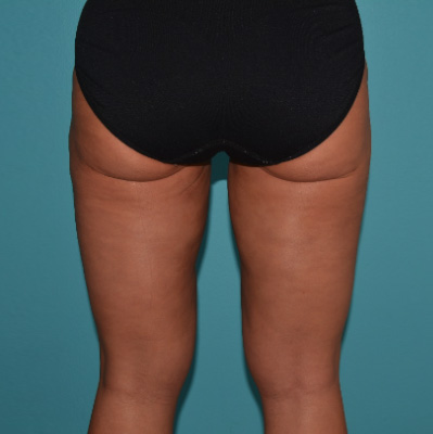 Tummy-tuck-p7-a2 After