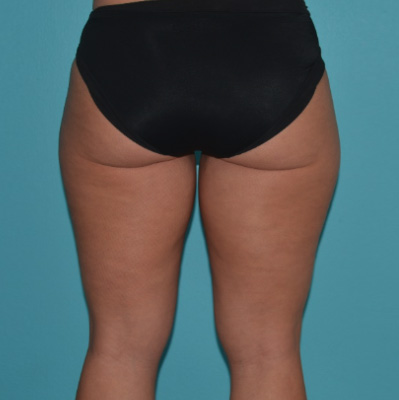 Tummy-tuck-p7-b2 Before