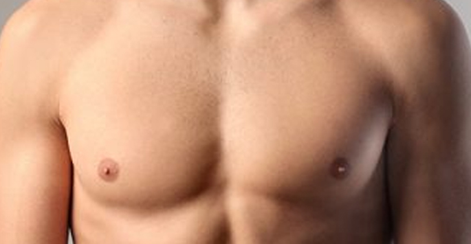 gynecomastia