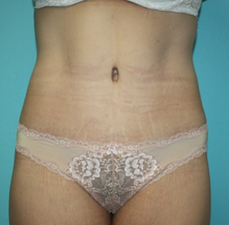 body-contouring-1-1a After