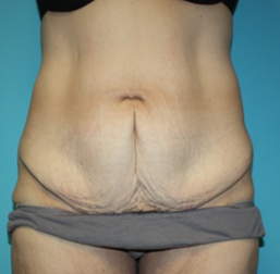 body-contouring-1-1b Before