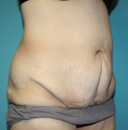 body-contouring-1-2b Before