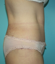 body-contouring-1-3a After