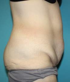 body-contouring-1-3b Before