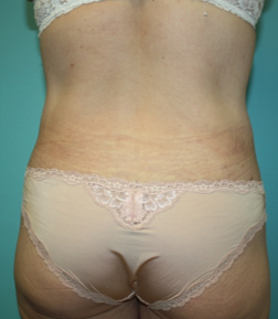 body-contouring-1-4a After