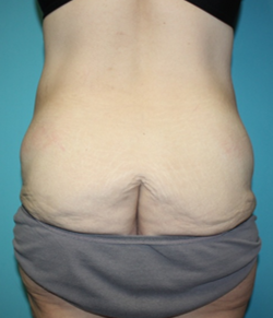 body-contouring-1-4b Before