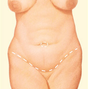 body-tummy-tuck-drawing1