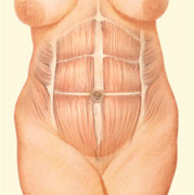 body-tummy-tuck-drawing2