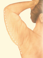 upper arm lift