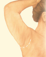 upper arm lift