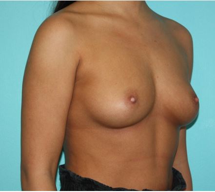 breast-augmentation-7-2b Before