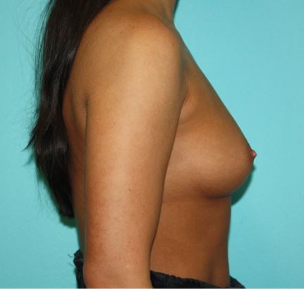 breast-augmentation-7-3b Before