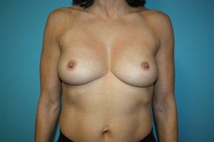 breast-augmentation-lift-1-1b Before
