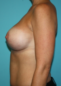 breast-augmentation-lift-2-3a After