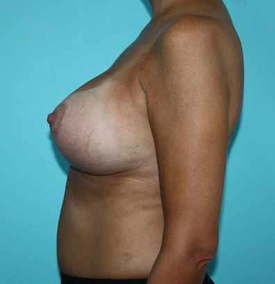 breast-lift-fkj-3a After
