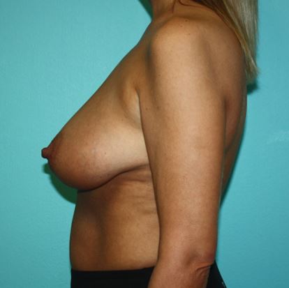 breast-lift-fkj-3b Before