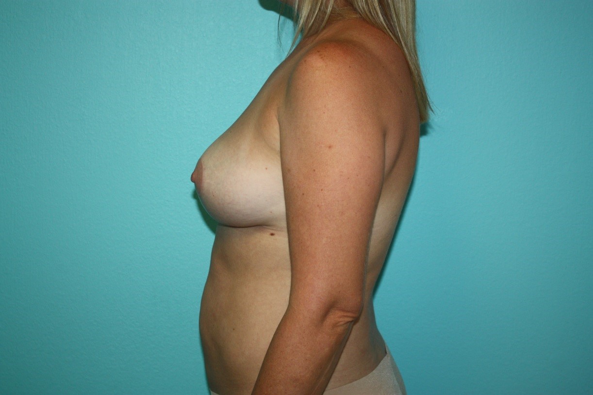 breast-lift-grg-3a After