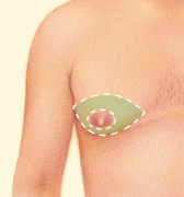 male breast reduction