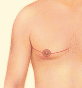 male breast reduction