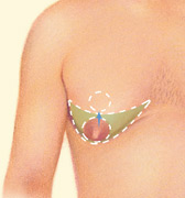 male breast reduction