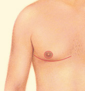 male breast reduction