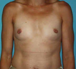 breast-reconstruction-1-1b Before