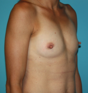 breast-reconstruction-1-2b Before