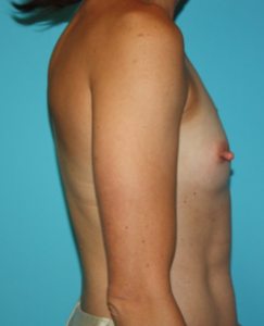 breast-reconstruction-1-3b Before