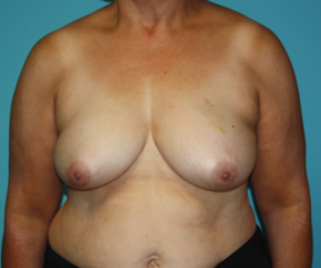 breast-reconstruction-2-1b Before