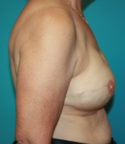 breast-reconstruction-2-3a After