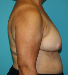 breast-reconstruction-2-3b Before