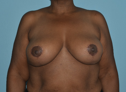 breast-reduction-5-a1 After