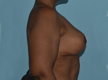 breast-reduction-5-a3 After