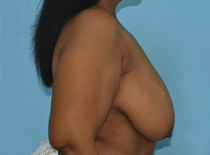 breast-reduction-5-b3 Before