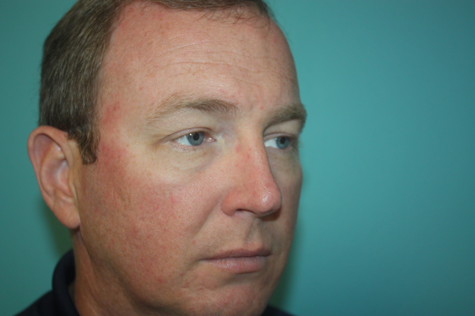 eyelid-g-2a After