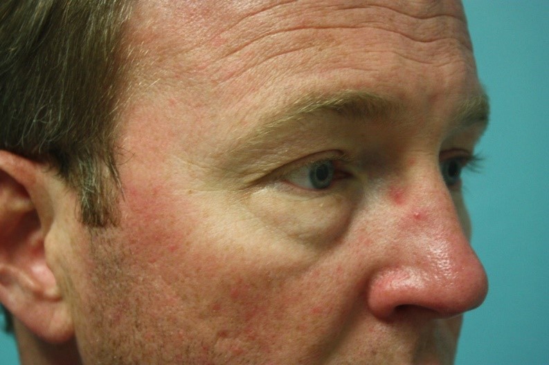 eyelid-g-2b Before