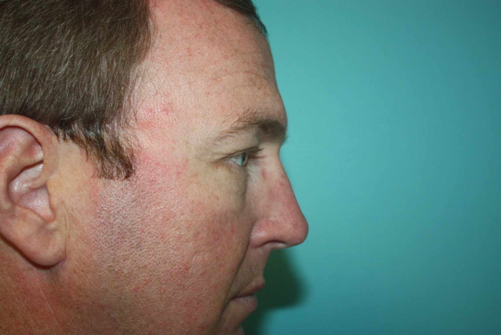 eyelid-g-3a After