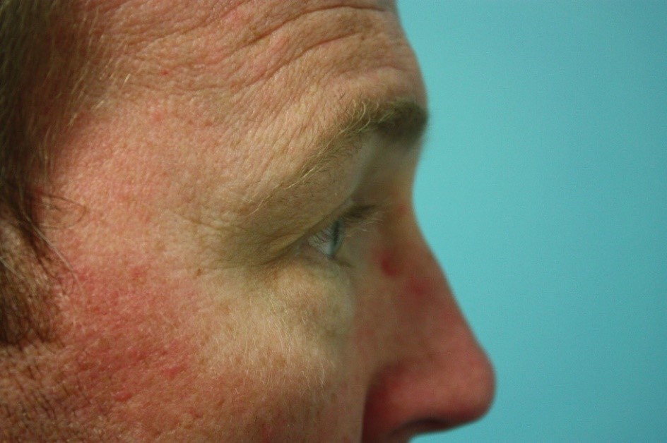 eyelid-g-3b Before