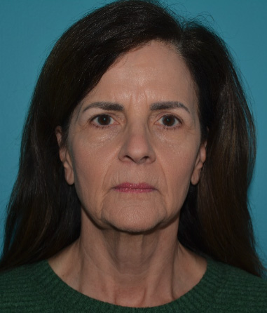 facelift-13-b1 Before