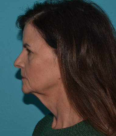 facelift-13-b3 Before