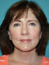 facelift-2-1a After