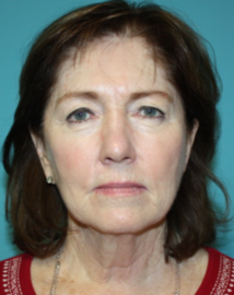 facelift-2-1b Before