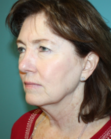 facelift-2-2b Before