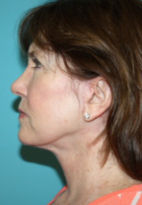 facelift-2-3a After