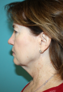 facelift-2-3b Before