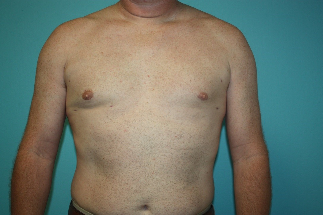 gynecomastia-h-1a After