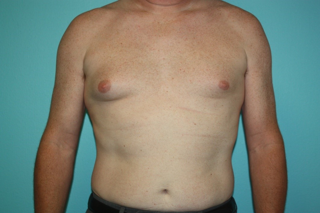 gynecomastia-h-1b Before