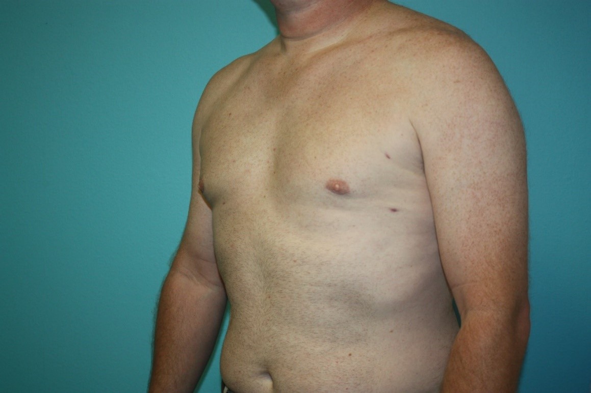 gynecomastia-h-2a After