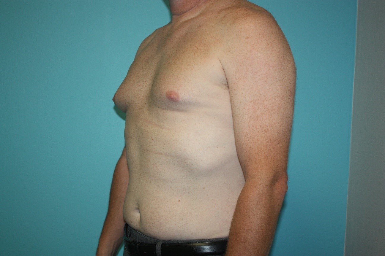 gynecomastia-h-2b Before